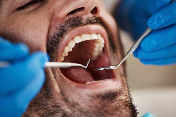 Best Emergency Treatment for Dental Infections or Abscesses in San Juan Bautista, CA